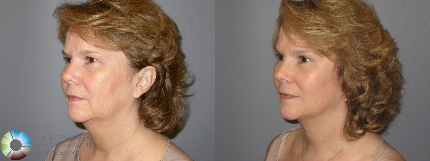 Before & After Eyelid Lift Case 116 View #2 View in Denver & Golden, CO