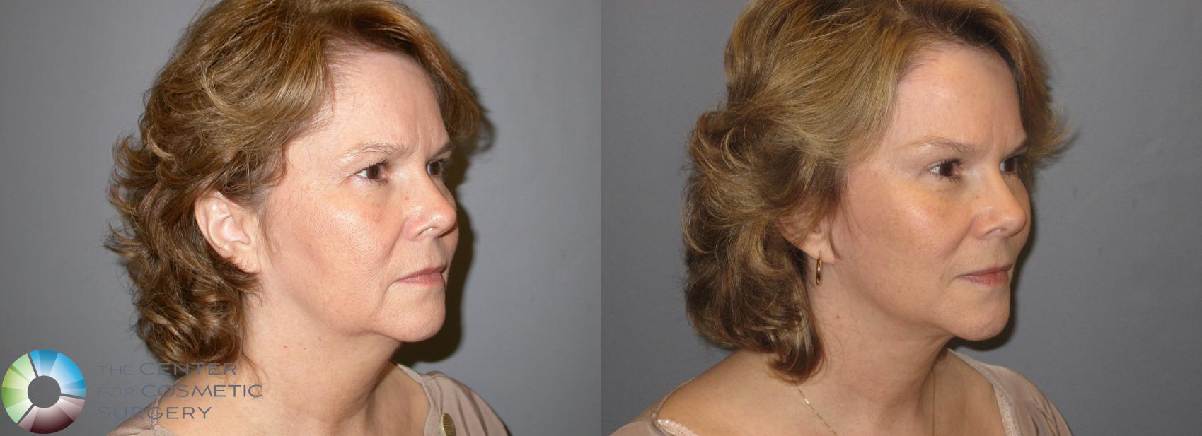 Before & After Mini Facelift Case 116 View #3 View in Denver & Golden, CO