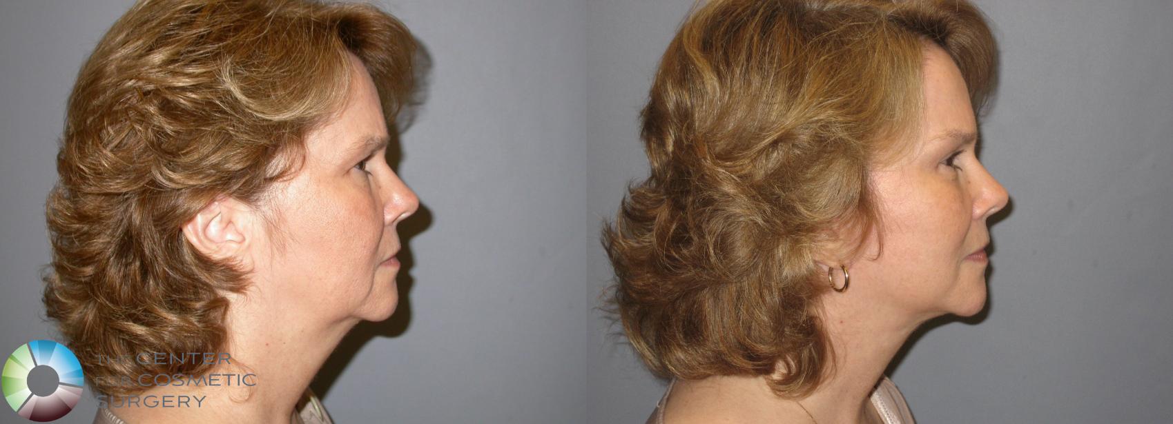 Before & After Mini Facelift Case 116 View #4 View in Golden, CO