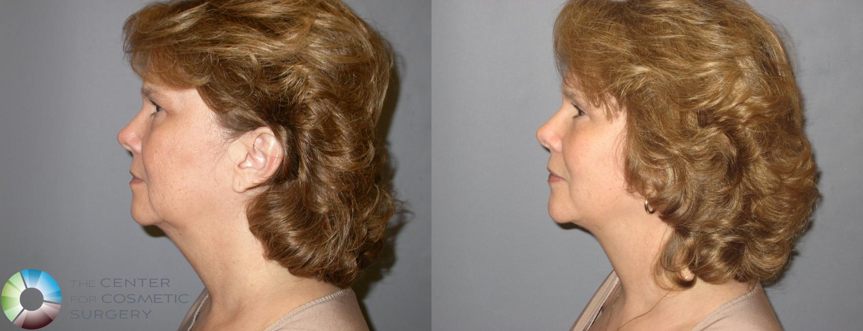 Before & After Mini Facelift Case 116 View #5 View in Denver & Golden, CO