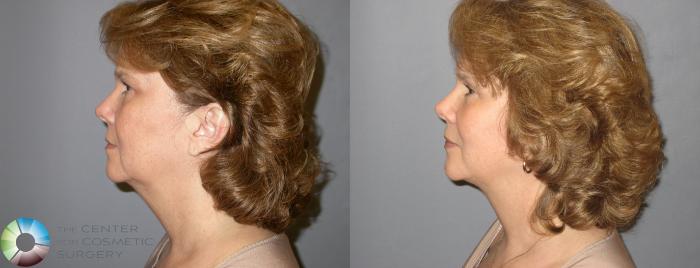 Before & After Mini Facelift Case 116 View #5 View in Golden, CO