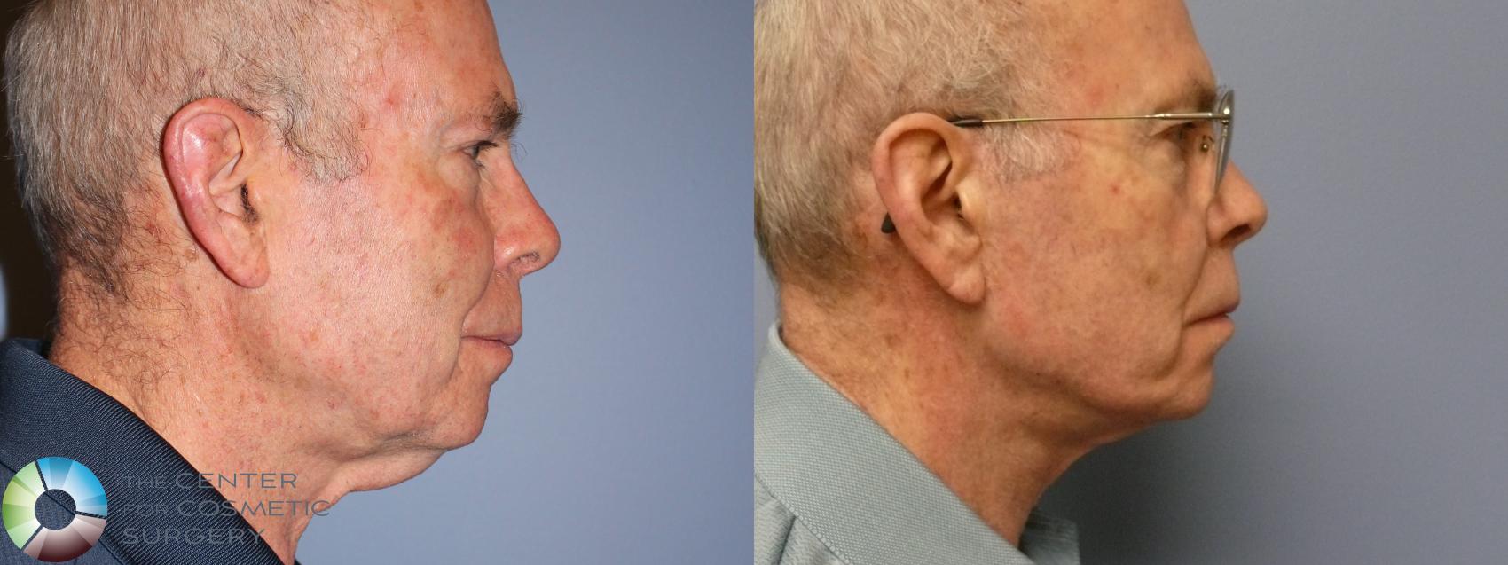 Best Denver Mini-Facelift/Necklift