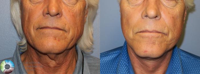 Before & After Mini Facelift Case 11653 Front in Denver and Colorado Springs, CO