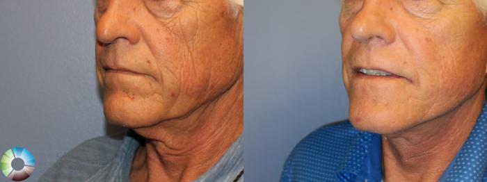 Before & After Mini Facelift Case 11653 Left Oblique in Denver and Colorado Springs, CO