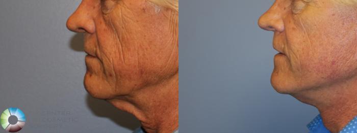 Before & After Neck Lift Case 11653 Left Side in Denver and Colorado Springs, CO