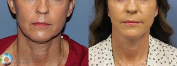 Before & After Mini Facelift Case 11694 Front in Denver and Colorado Springs, CO