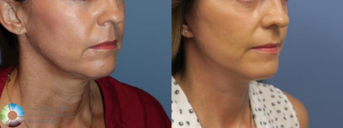 Before & After Mini Facelift Case 11694 Right Oblique in Denver and Colorado Springs, CO