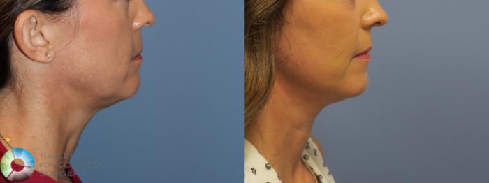 Before & After Mini Facelift Case 11694 Right Side in Denver and Colorado Springs, CO