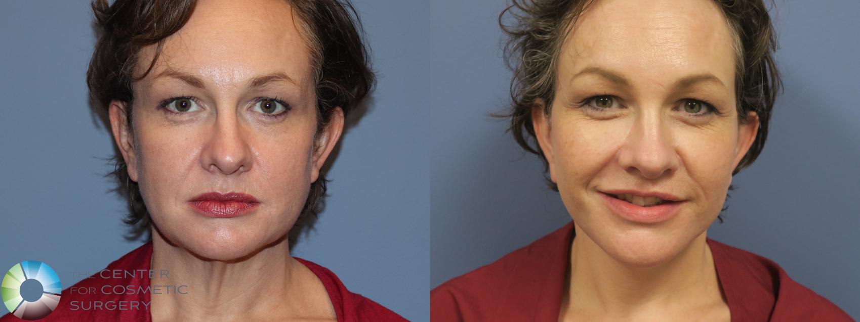 Best Denver Mini-Facelift