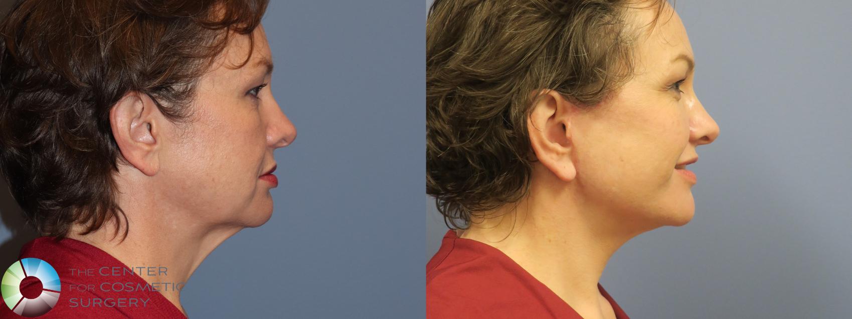 Before & After Mini Facelift Case 11696 Right Side in Denver and Colorado Springs, CO