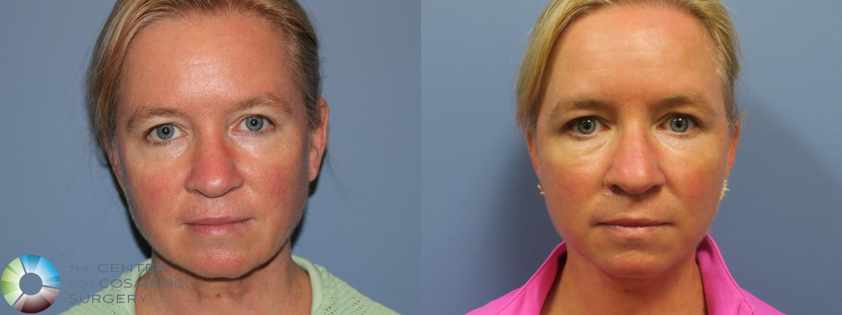 Before & After Mini Facelift Case 11699 Front in Denver and Colorado Springs, CO
