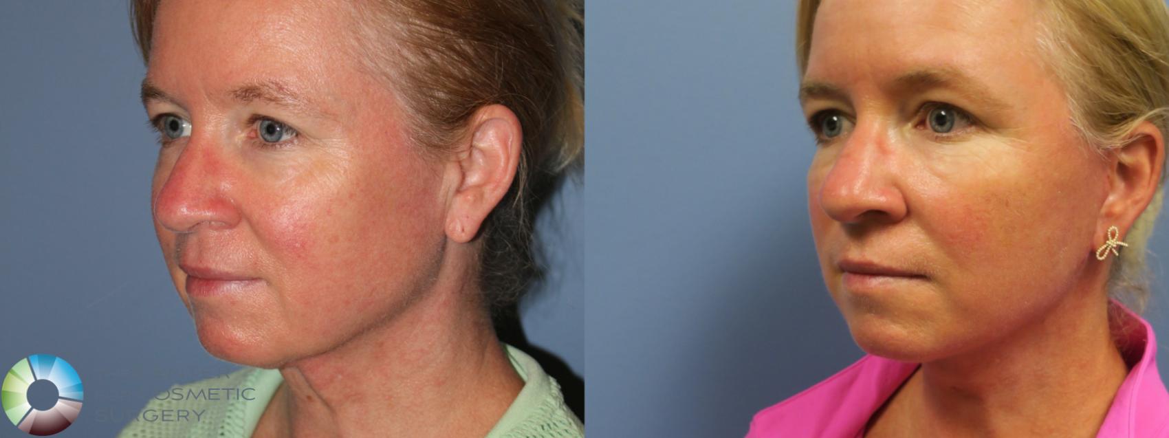 Before & After Mini Facelift Case 11699 Left Oblique in Denver and Colorado Springs, CO