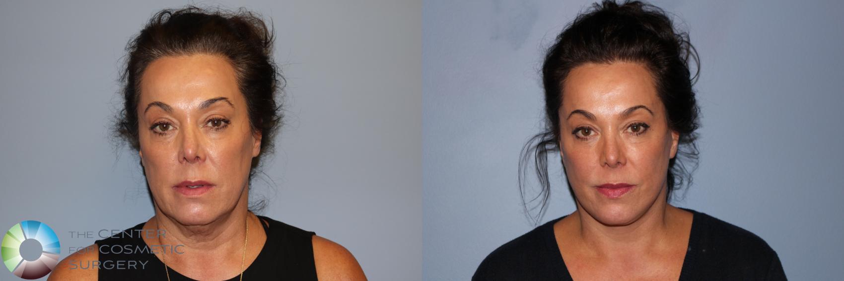 Before & After Neck Lift Case 11735 Front in Denver and Colorado Springs, CO