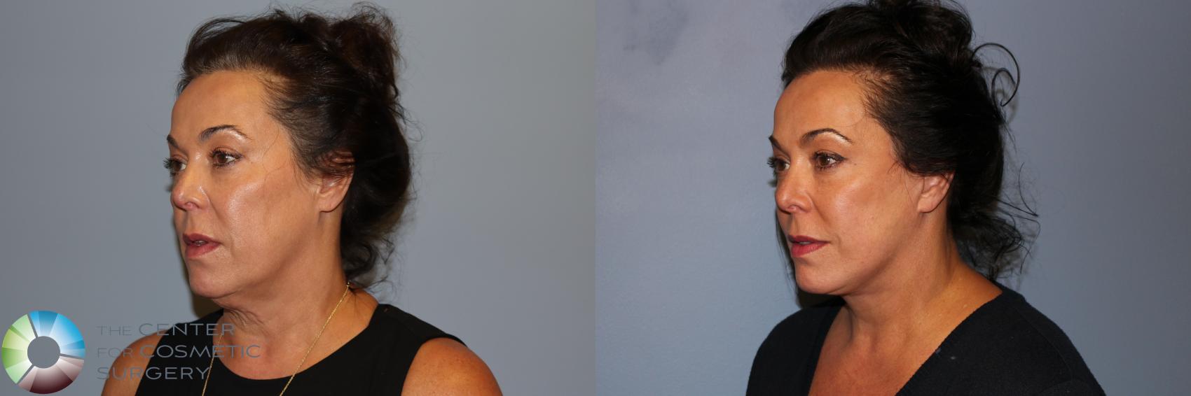 Before & After Mini Facelift Case 11735 Left Oblique in Denver and Colorado Springs, CO