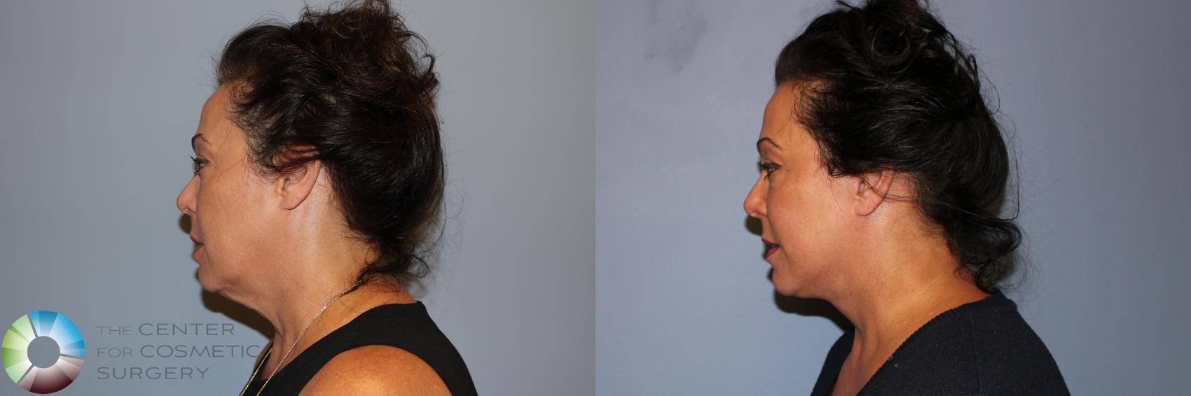 Before & After Mini Facelift Case 11735 Right Side in Denver and Colorado Springs, CO