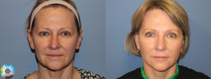 Before & After Mini Facelift Case 11742 Front View in Golden, CO