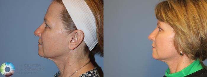 Before & After Mini Facelift Case 11742 Left Side View in Golden, CO