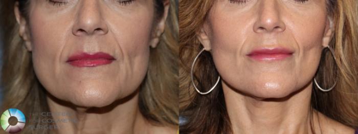 Before & After Mini Facelift Case 11748 Front in Denver and Colorado Springs, CO