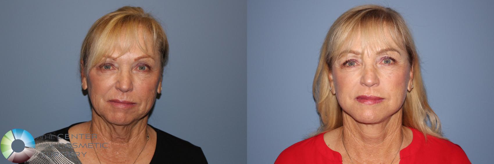 Before & After Mini Facelift Case 11773 Front in Denver and Colorado Springs, CO
