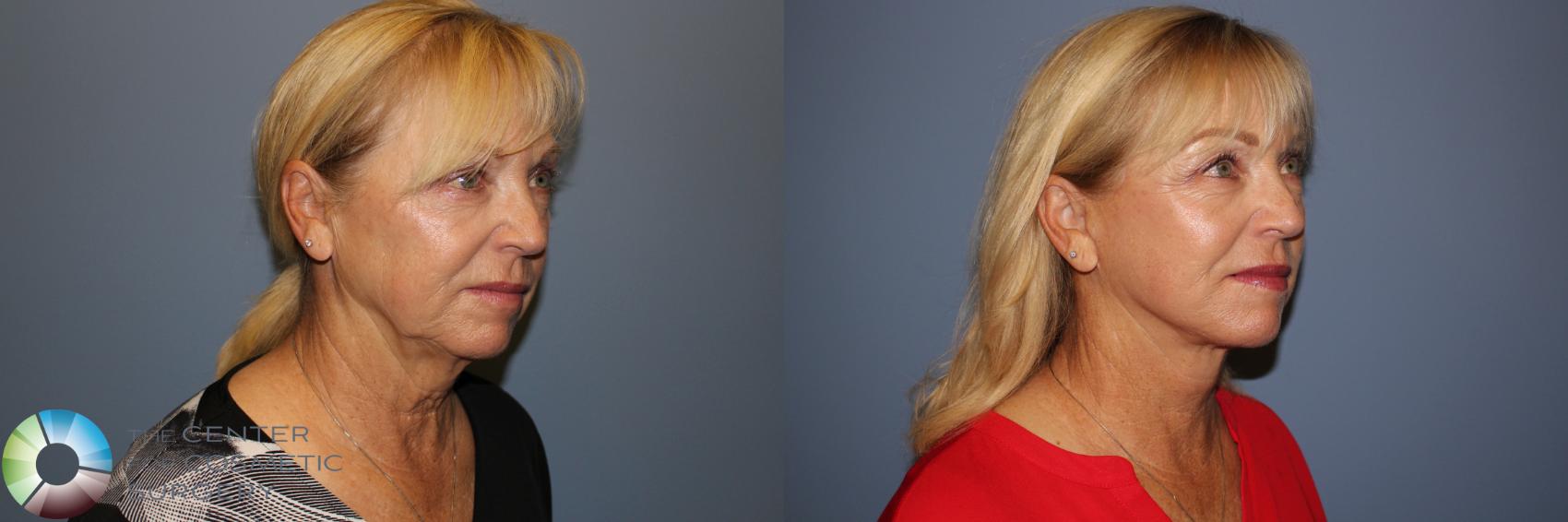 Before & After Mini Facelift Case 11773 Right Oblique in Denver and Colorado Springs, CO