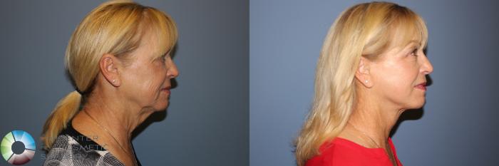 Before & After Mini Facelift Case 11773 Right Side View in Golden, CO