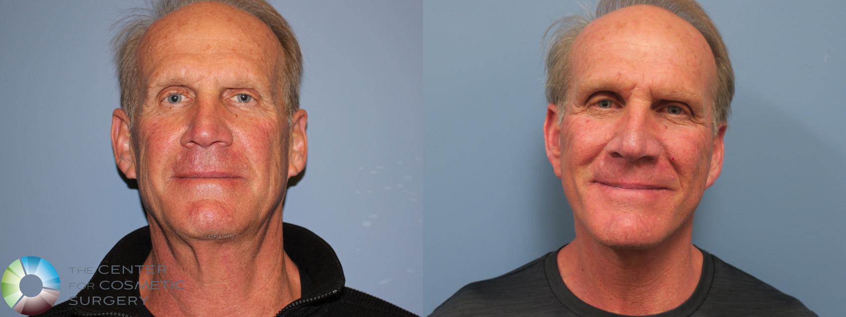 Before & After Mini Facelift Case 11782 Front in Denver and Colorado Springs, CO