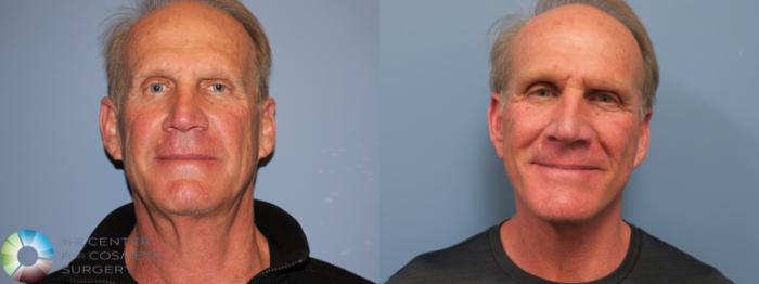 Before & After Mini Facelift Case 11782 Front View in Golden, CO