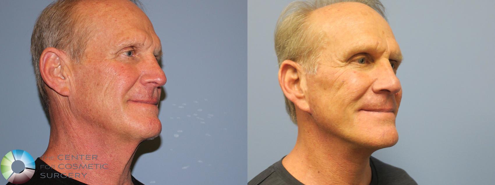 Before & After Mini Facelift Case 11782 Right Oblique in Denver and Colorado Springs, CO