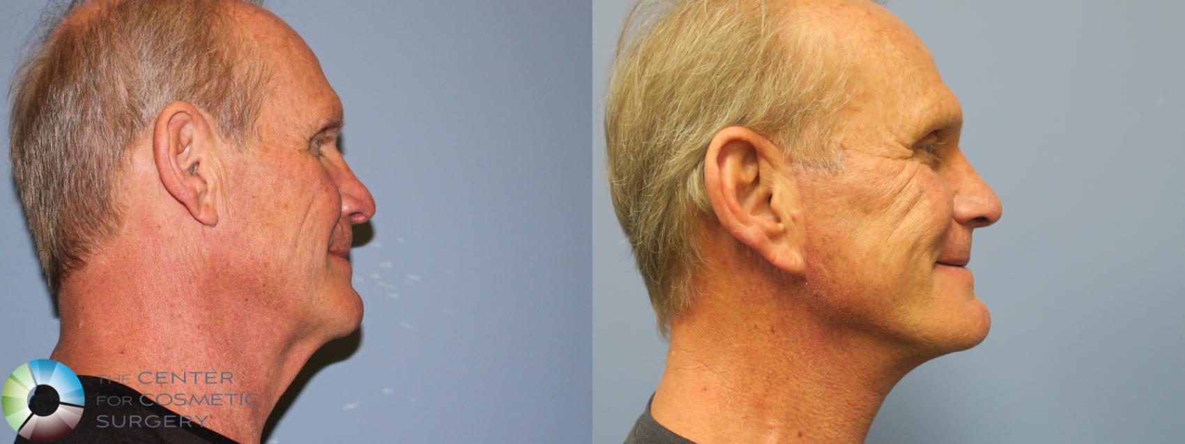 Before & After Neck Lift Case 11782 Right Side in Denver and Colorado Springs, CO