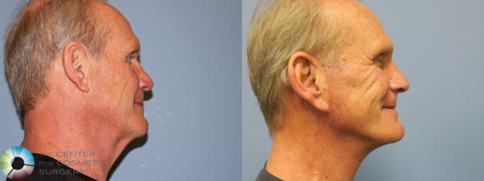Before & After Mini Facelift Case 11782 Right Side View in Golden, CO