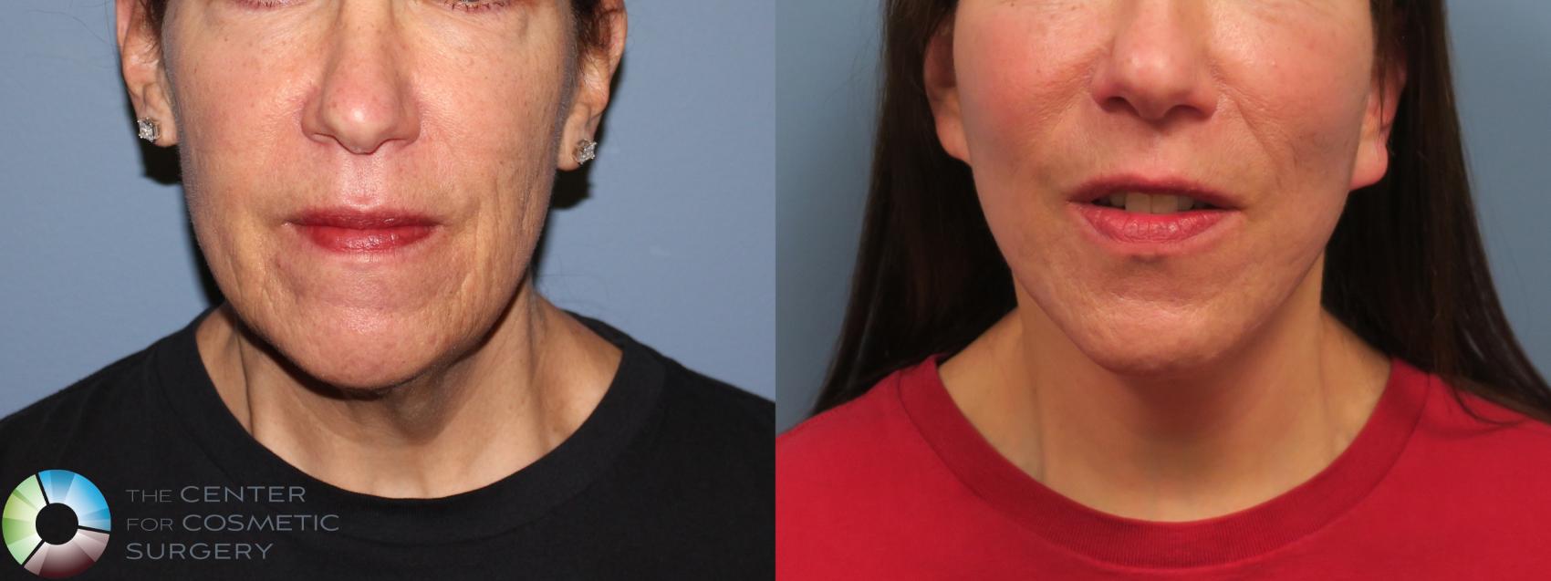 Before & After Mini Facelift Case 11791 Front in Denver and Colorado Springs, CO