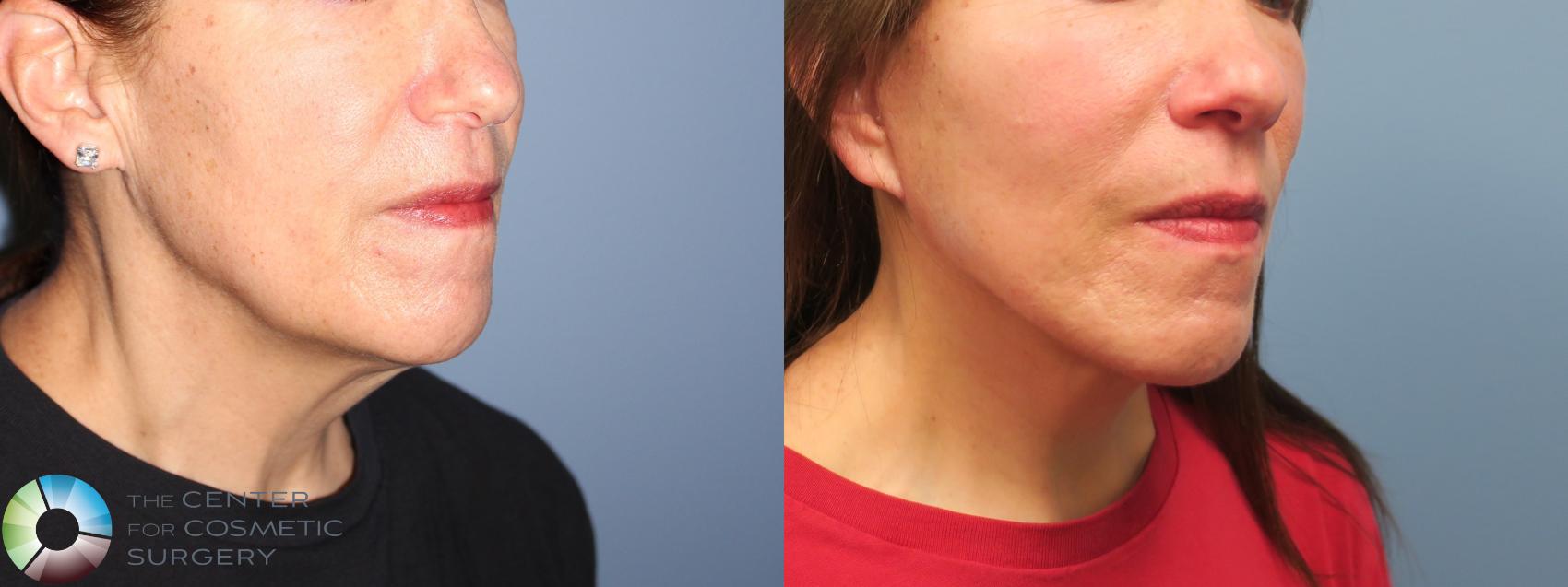 Before & After Mini Facelift Case 11791 Right Oblique in Denver and Colorado Springs, CO