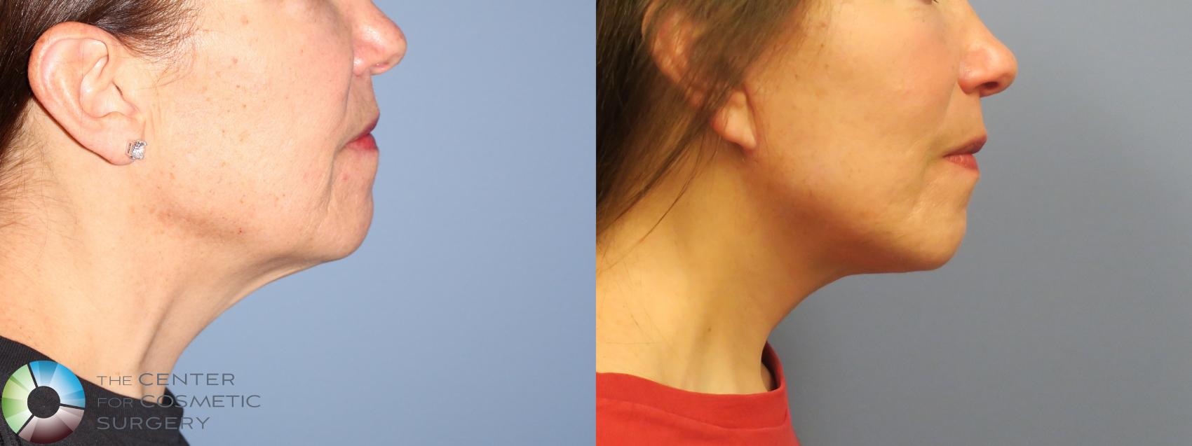 Before & After Mini Facelift Case 11791 Right Side in Denver and Colorado Springs, CO