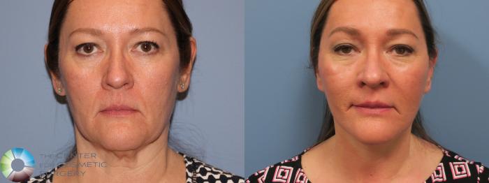 Before & After Mini Facelift Case 11792 Front in Denver and Colorado Springs, CO