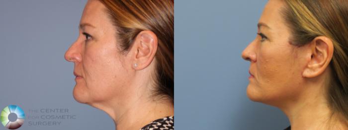 Before & After Mini Facelift Case 11792 Left Side in Denver and Colorado Springs, CO