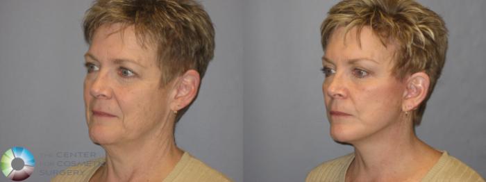 Before & After Mini Brow Lift Case 118 View #1 View in Golden, CO