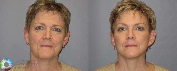 Before & After Mini Brow Lift Case 118 View #2 View in Golden, CO