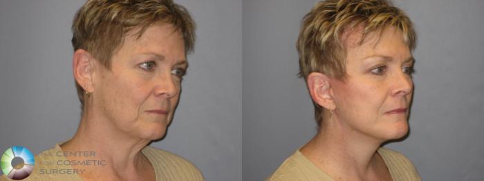 Before & After Mini Brow Lift Case 118 View #3 View in Golden, CO