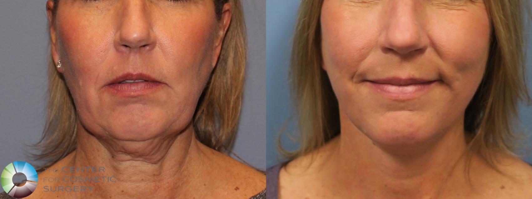 Before & After Mini Facelift Case 11847 Front View in Golden, CO