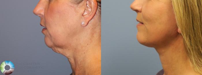 Before & After Mini Facelift Case 11847 Left Side View in Golden, CO