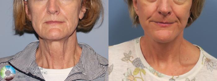 Before & After Neck Lift Case 11848 Front in Denver and Colorado Springs, CO