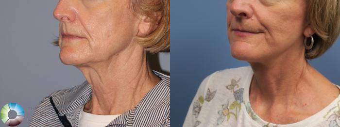 Before & After Neck Lift Case 11848 Left Oblique in Denver and Colorado Springs, CO