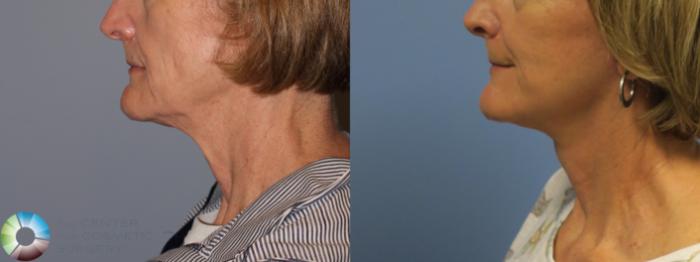 Before & After Neck Lift Case 11848 Left Side in Denver and Colorado Springs, CO