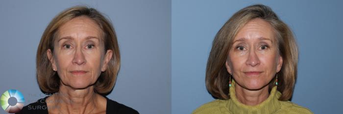 Before & After Mini Facelift Case 11873 Front View in Golden, CO