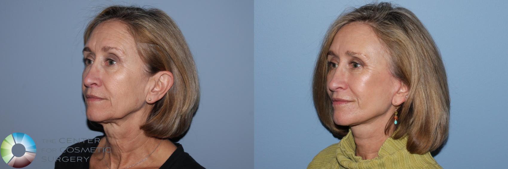 Before & After Mini Facelift Case 11873 Left Oblique in Denver and Colorado Springs, CO