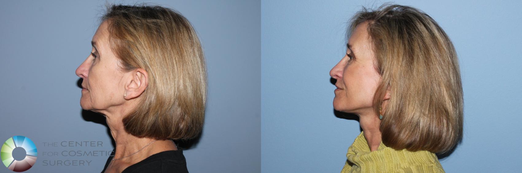 Before & After Mini Facelift Case 11873 Left Side in Denver and Colorado Springs, CO