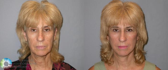 Before & After Mini Facelift Case 11876 Front View in Golden, CO