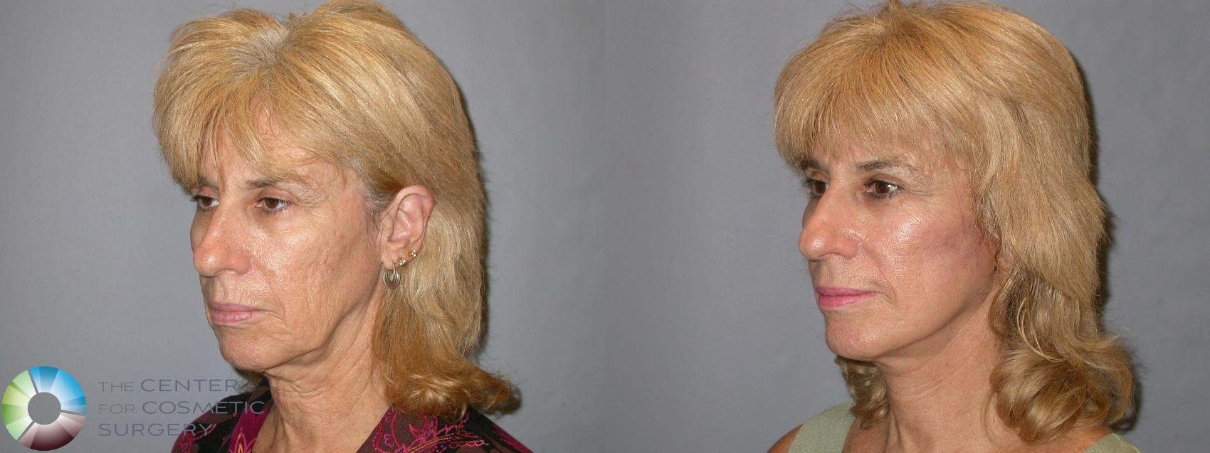 Before & After Mini Facelift Case 11876 Left Oblique in Denver and Colorado Springs, CO