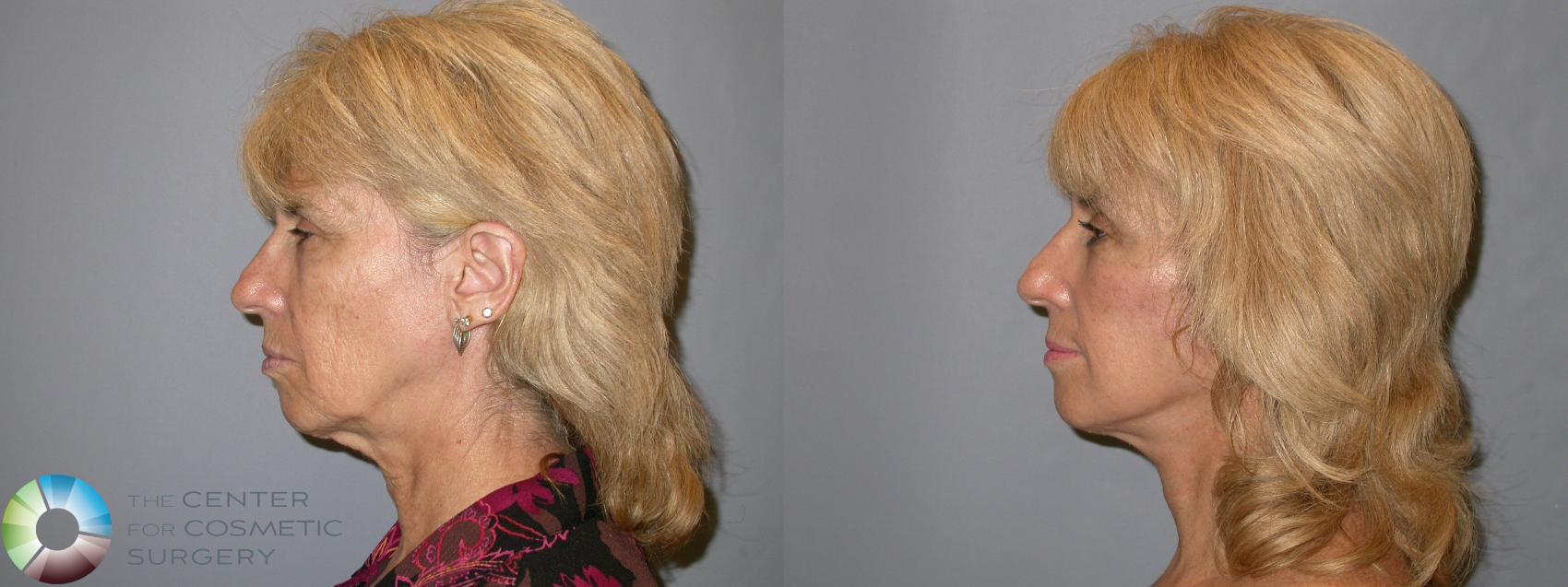 Before & After Mini Facelift Case 11876 Left Side in Denver and Colorado Springs, CO