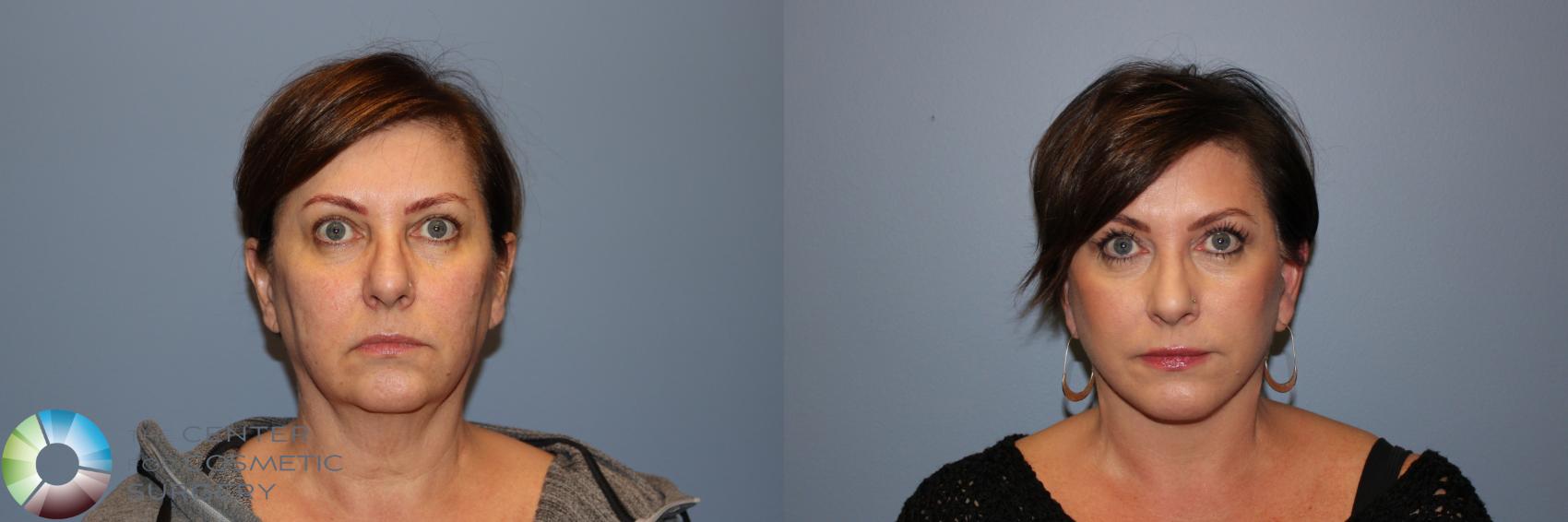 Before & After Mini Facelift Case 11877 Front in Denver and Colorado Springs, CO